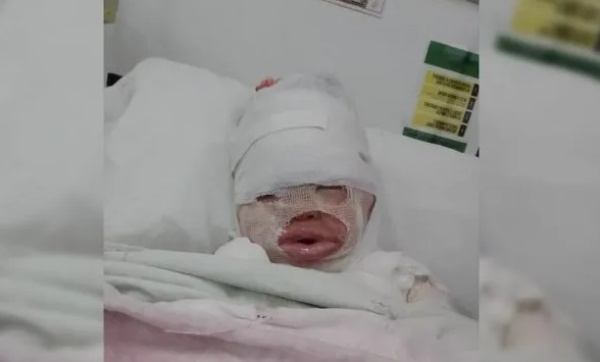 Habló la mamá de Brianna, la nena quemada con aceite hirviendo que está internada en La Plata: "Le dan morfina por el dolor"