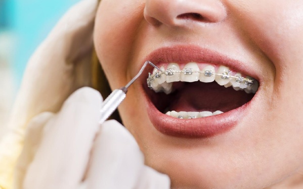 Prohibieron la distribución de dos productos médicos para ortodoncia